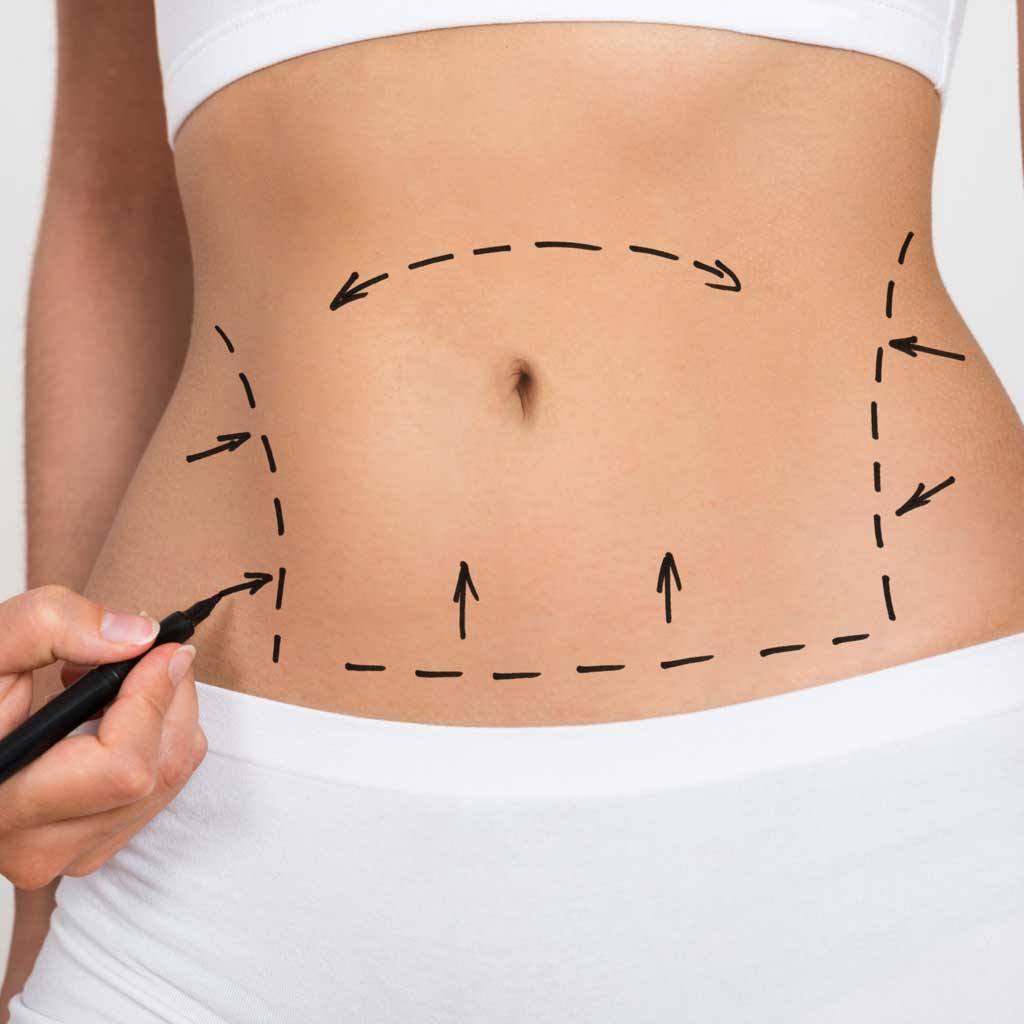 Liposuction