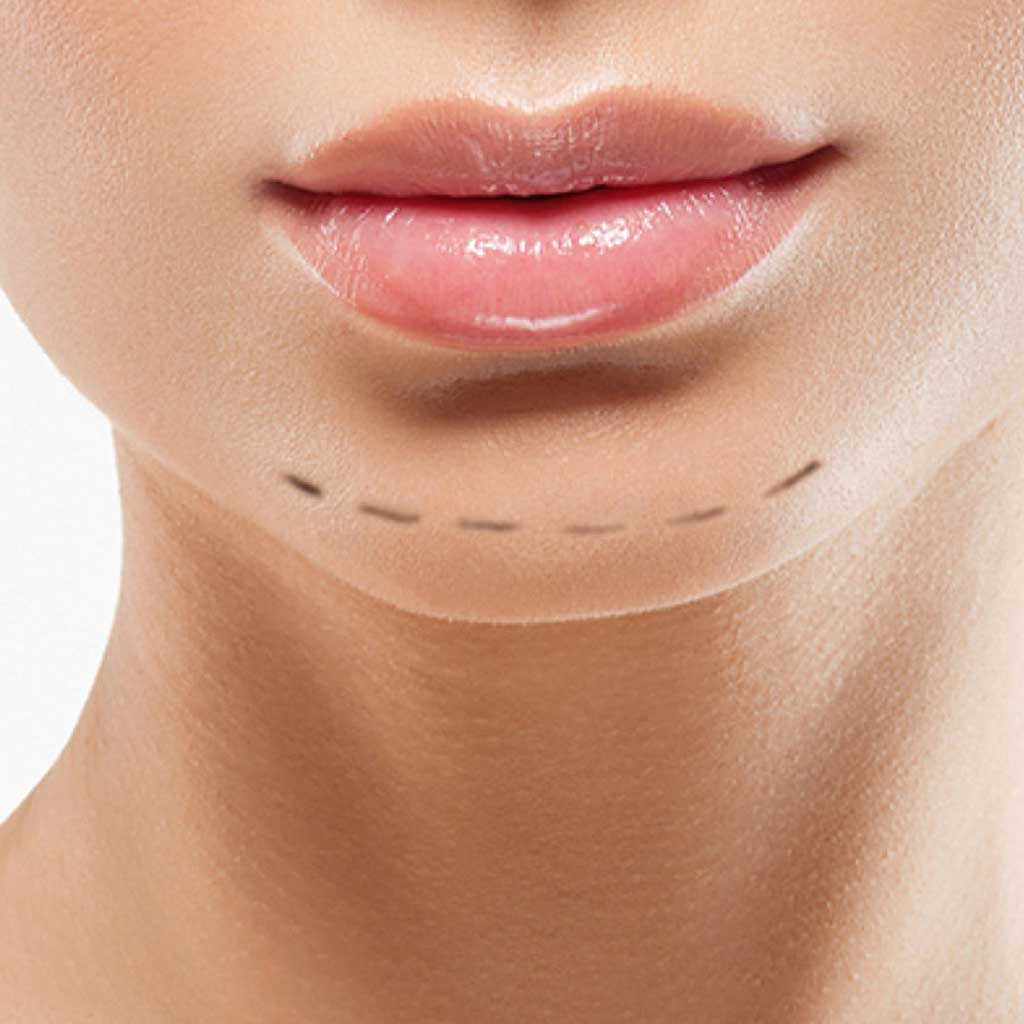 chin-augmentation-