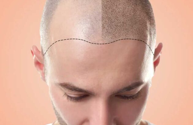 hair-transplant-delhi