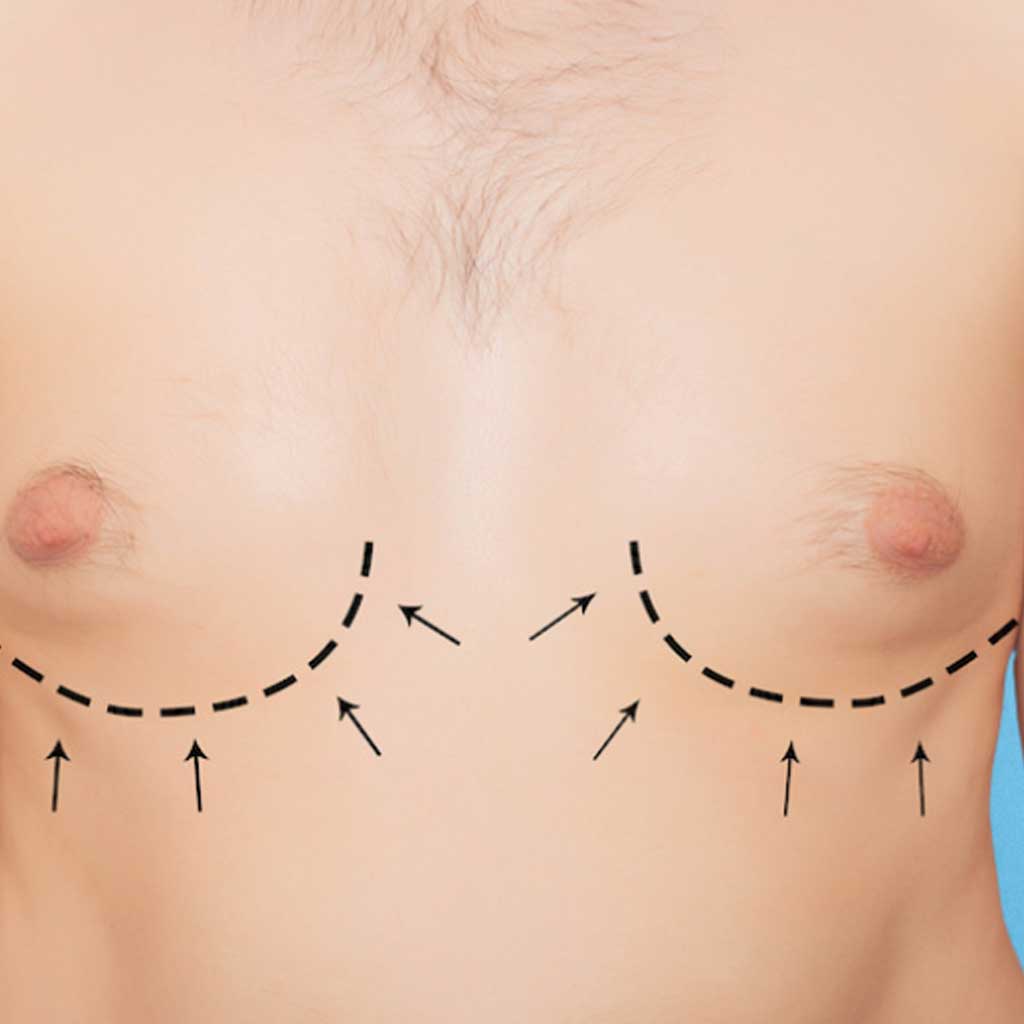 male-breast-reduction