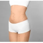 Gastric Bypass Surgery