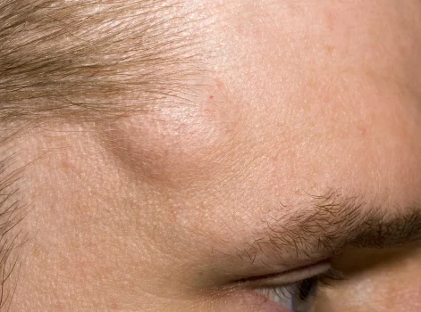 Cosmetically Sensitive Area Lipoma Removal