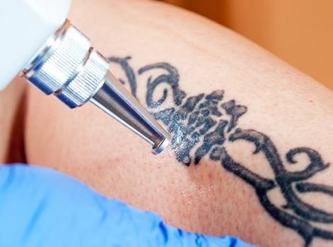 Laser Tattoo Removal Treatment in Delhi