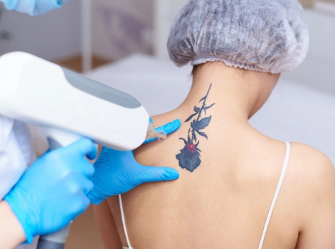Laser Tattoo Removal Treatment in Delhi