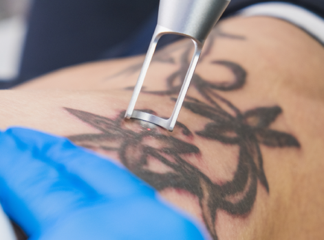 Laser Tattoo Removal Treatment in Delhi