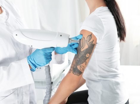 Laser Tattoo Removal Treatment in Delhi
