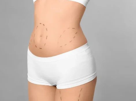 Gastric Bypass Surgery