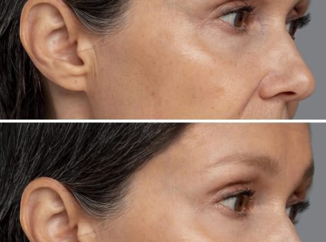 Micro Needling Treatment in Delhi