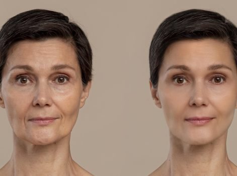 MNRF Treatment in Delhi