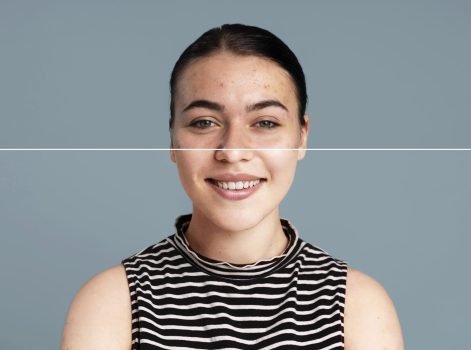 IPL Photofacial Treatment in Delhi