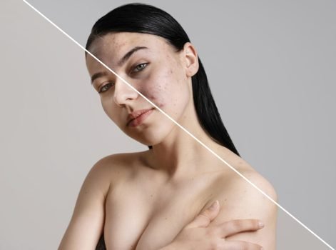 Micro Needling Treatment in Delhi