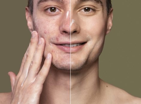 Chemical Peeling treatment in Delhi