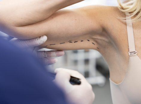 Arm Lift (Brachioplasty)