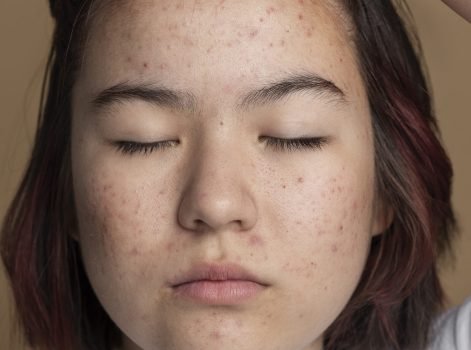 Skin Treatment in Delhi