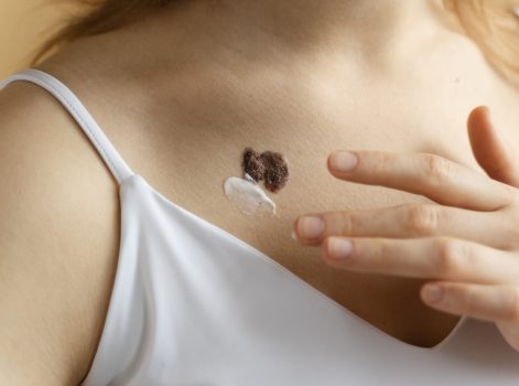 Keloid and Hypertrophic Scar