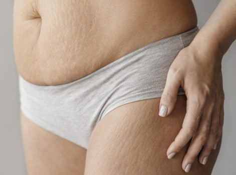 Micro Needling Treatment in Delhi