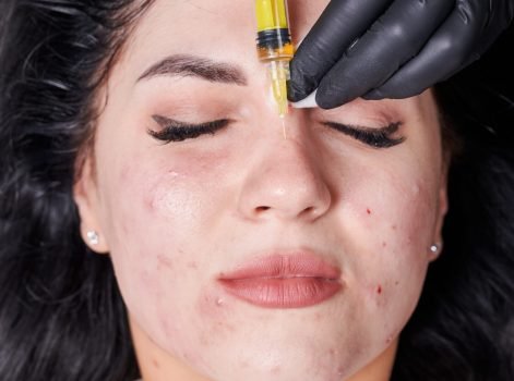 PRP Face Treatment in Delhi