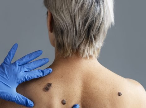 Mole & Skin Tag Removal Treatment in Delhi