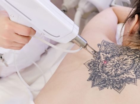 laser-tattoo-removal Laser Tattoo Removal Treatment in Delhi