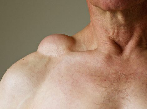 Deep-Seated Lipoma Removal