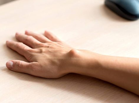 Revision Lipoma Surgery