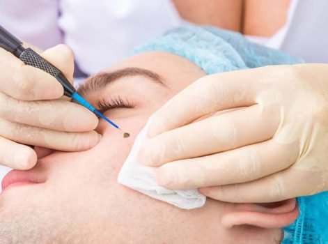 mole-removal-skin-tag-removal mole-removal-skin-tag-removal