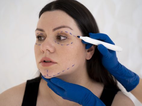 Mid-Face Thread Lift