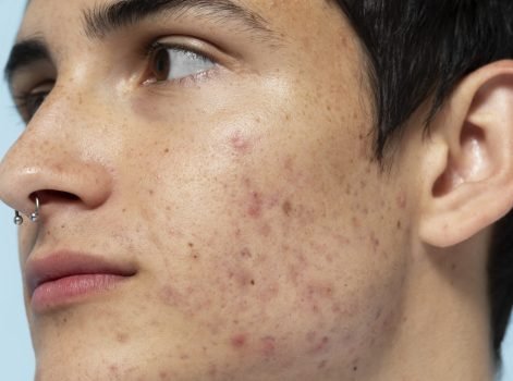 IPL Photofacial Treatment in Delhi