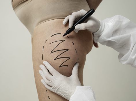 Body Lift Surgery in Delhi