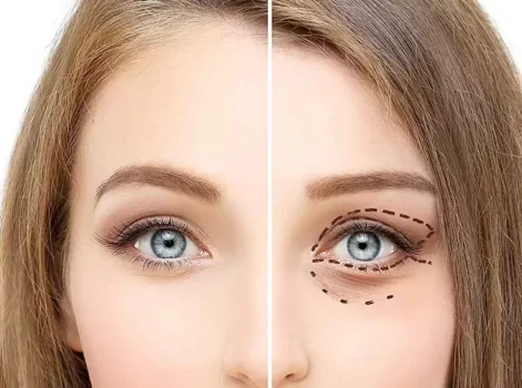 Transconjunctival Eyelid Surgery