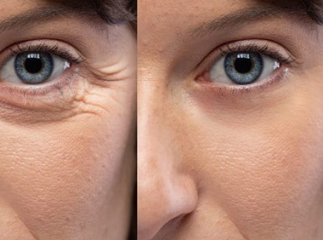 Crow's Feet Reduction