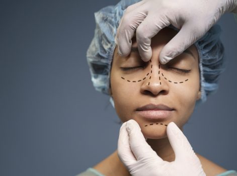 Traditional Face Lift