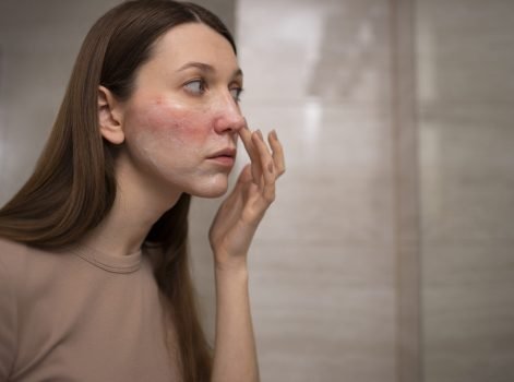 IPL Photofacial Treatment in Delhi